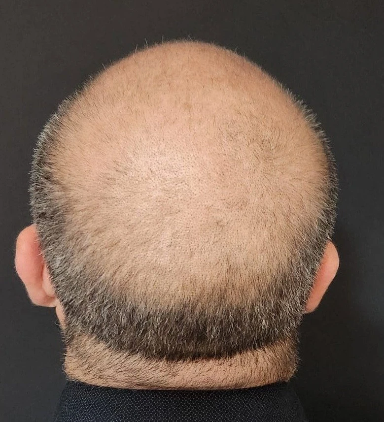 Harmonização Facial