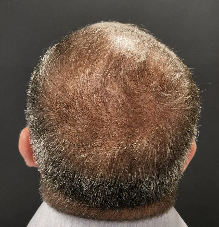 Tratamento Avançado